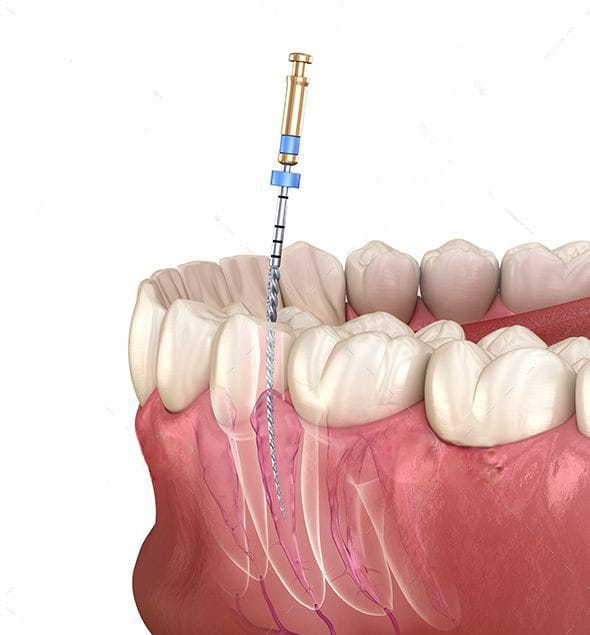 Root Canal Treatment